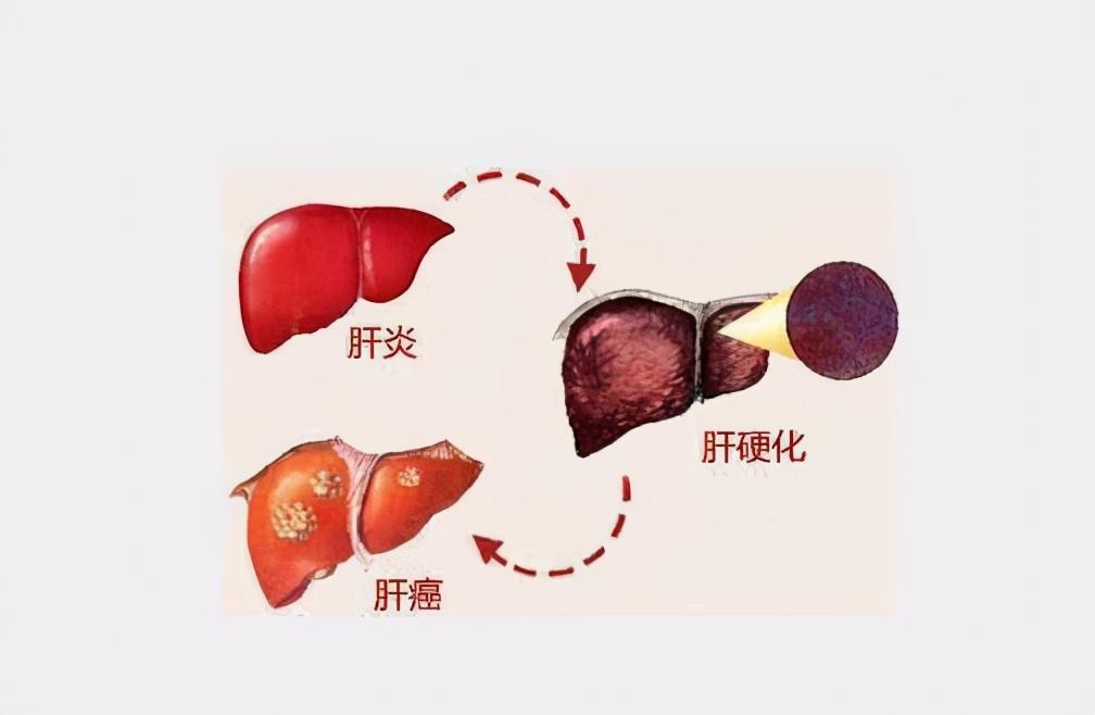 专家讲坛肝硬化恶化的症状表现,肝硬化引起肝衰竭怎么办
