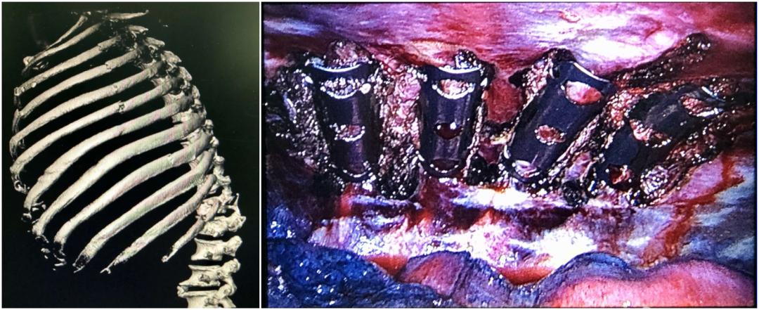 太原市中心医院心胸外科,太原中心医院汾东院区胸外科