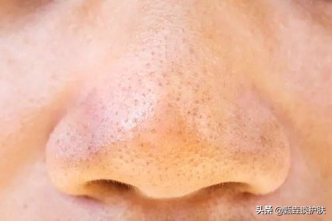 鼻子挤出白色条状物中医,鼻子边挤出白色条状物留下一个洞