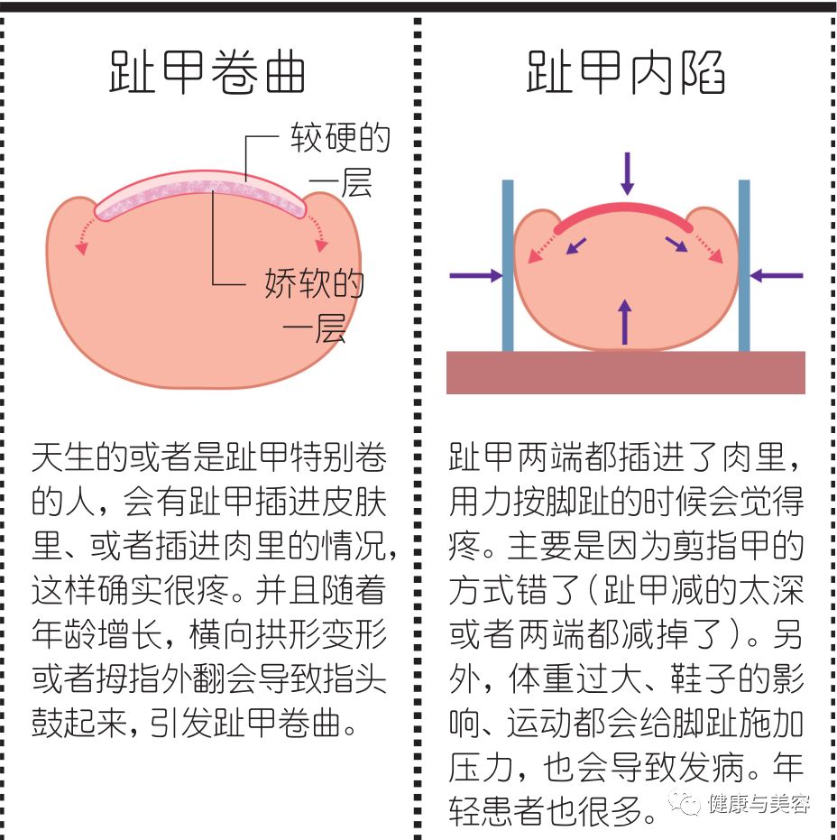 脚趾甲已经剪成圆形怎么办,脚趾甲长进肉怎么剪才不会痛