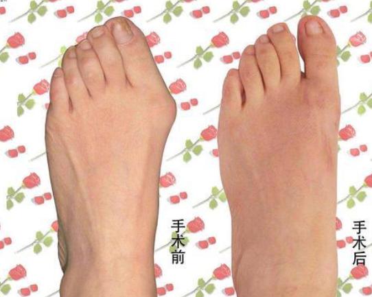 长期穿高跟鞋会引起拇外翻吗,拇外翻穿高跟鞋怎么避免疼