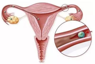 输卵管细小通而不畅能自然怀孕吗,输卵管一侧堵塞一侧通能怀孕吗