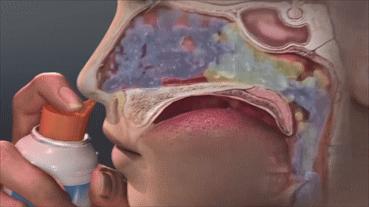 过敏性鼻炎太难缠？教你3个简单方法