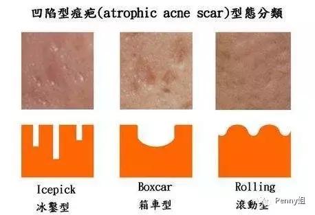 如何有效去除痘印痘痘,治疗痘印痘疤费用