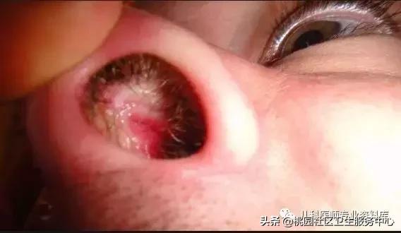 过敏性鼻炎手术的全过程,治疗过敏性鼻炎有效的药