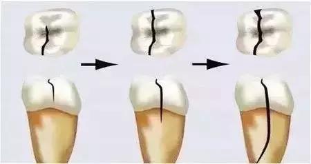 嘎嘣脆的牙齿,牙齿碎裂因为什么