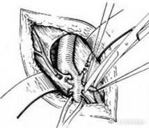 精索静脉曲张的误区,当心陷入静脉曲张的误区