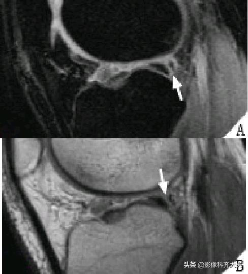 膝关节半月板损伤的磁共振,膝关节半月板病变的mri诊断与鉴别