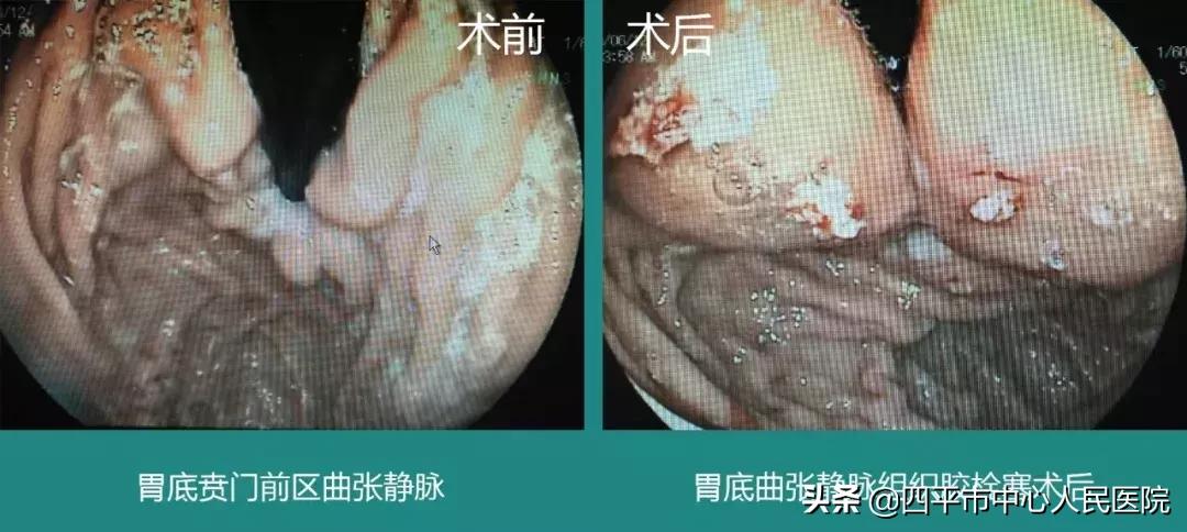 四平中心医院治疗静脉曲张,食管静脉曲张精准化治疗