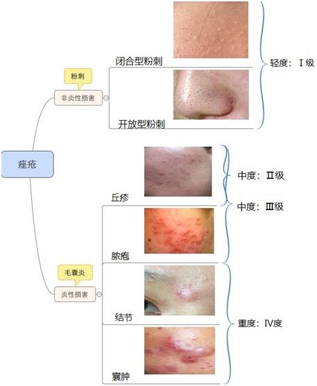 痘痘小问题,痘痘问题肌肤