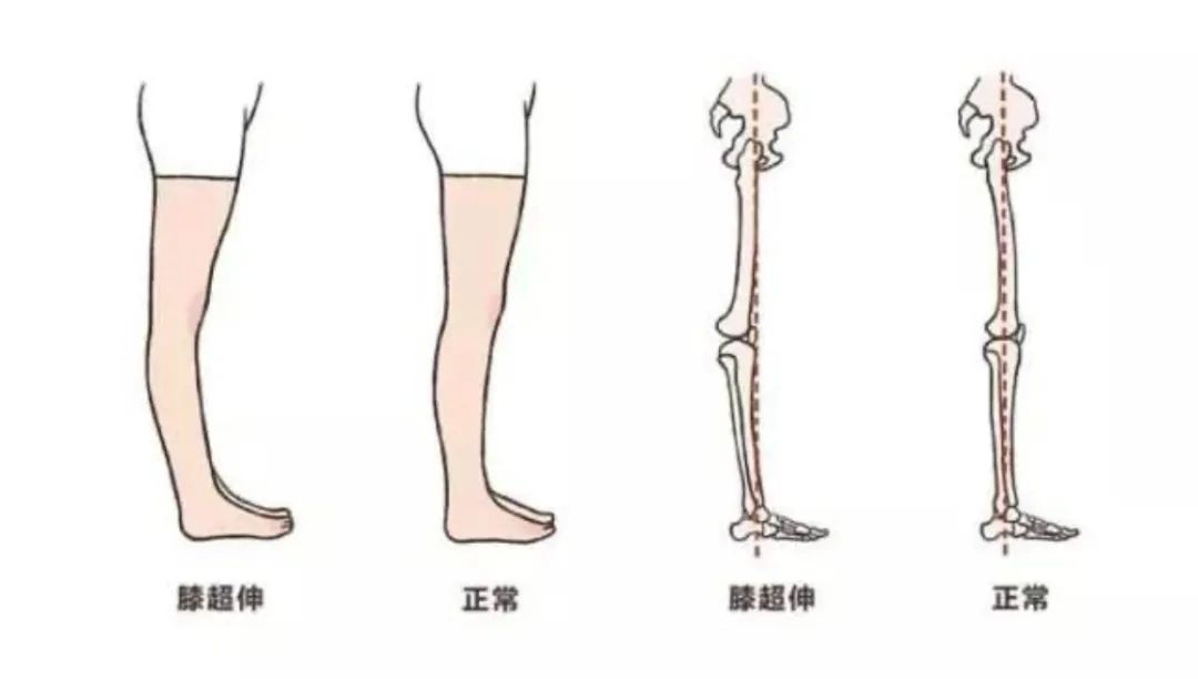 膝超伸腿粗运动可以改善吗,大粗腿膝超伸矫正方法图解