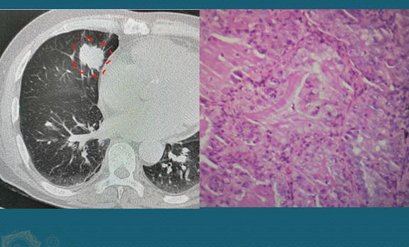 31岁肺癌自愈案例,三十岁肺癌晚期