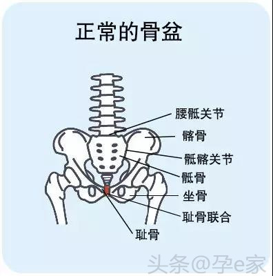摆脱大屁股恢复蜜桃臀，骨盆修复真的有用吗？