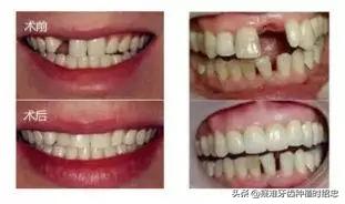 孩子牙只剩残根怎么换牙,只剩残根的牙真的能补救吗