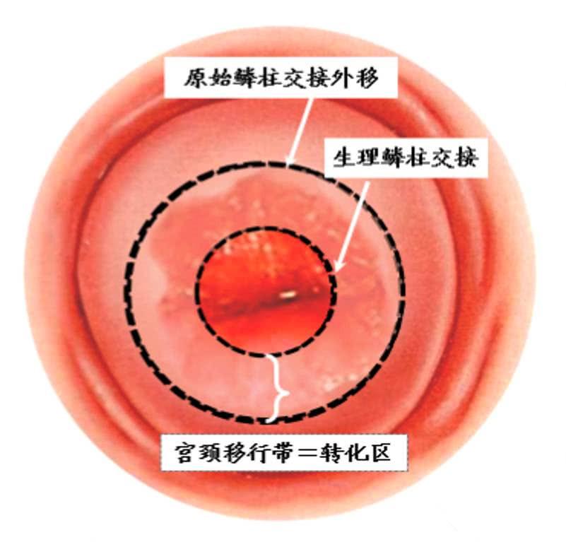 宫颈糜烂囊肿肥大需要怎么治疗呀,宫颈2度糜烂见纳氏囊肿什么意思