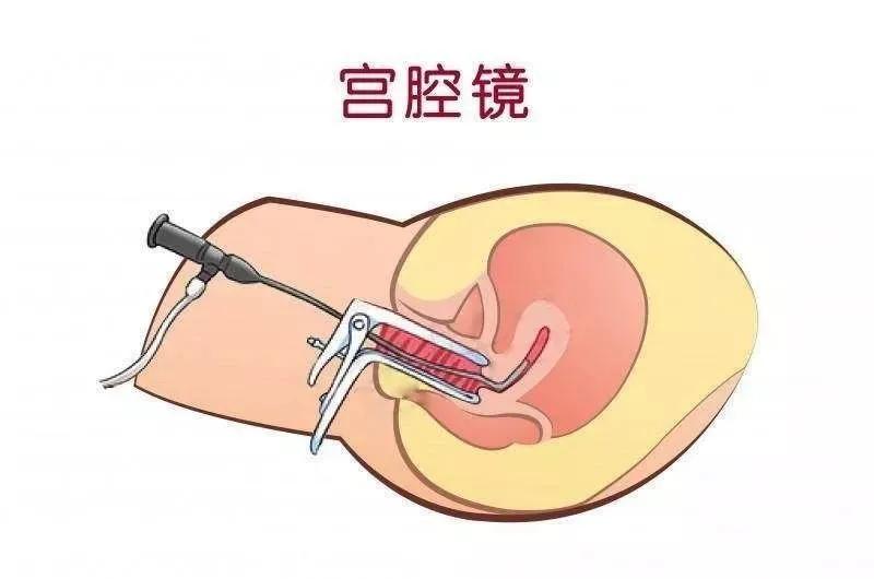 结婚10年，4次宫腔镜，2年试管，第4次移植终于迎来好孕