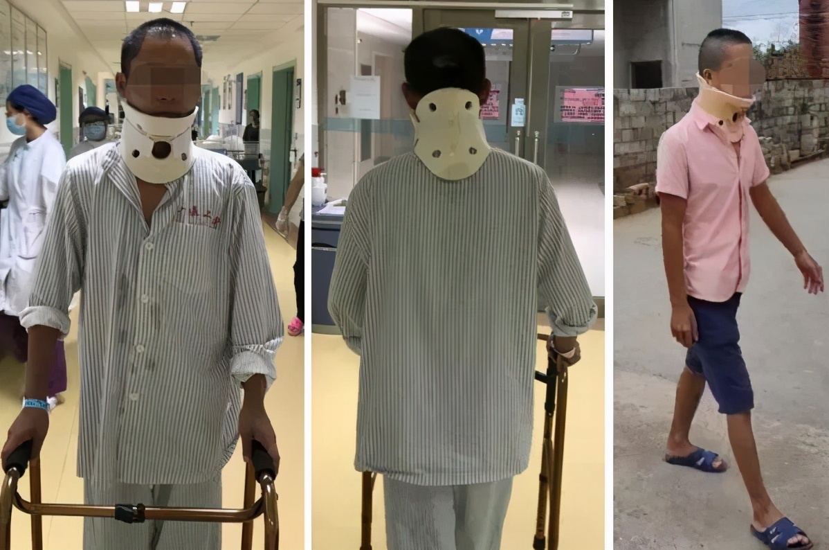 颈椎粉碎性骨折,颈椎粉碎性骨折后期康复