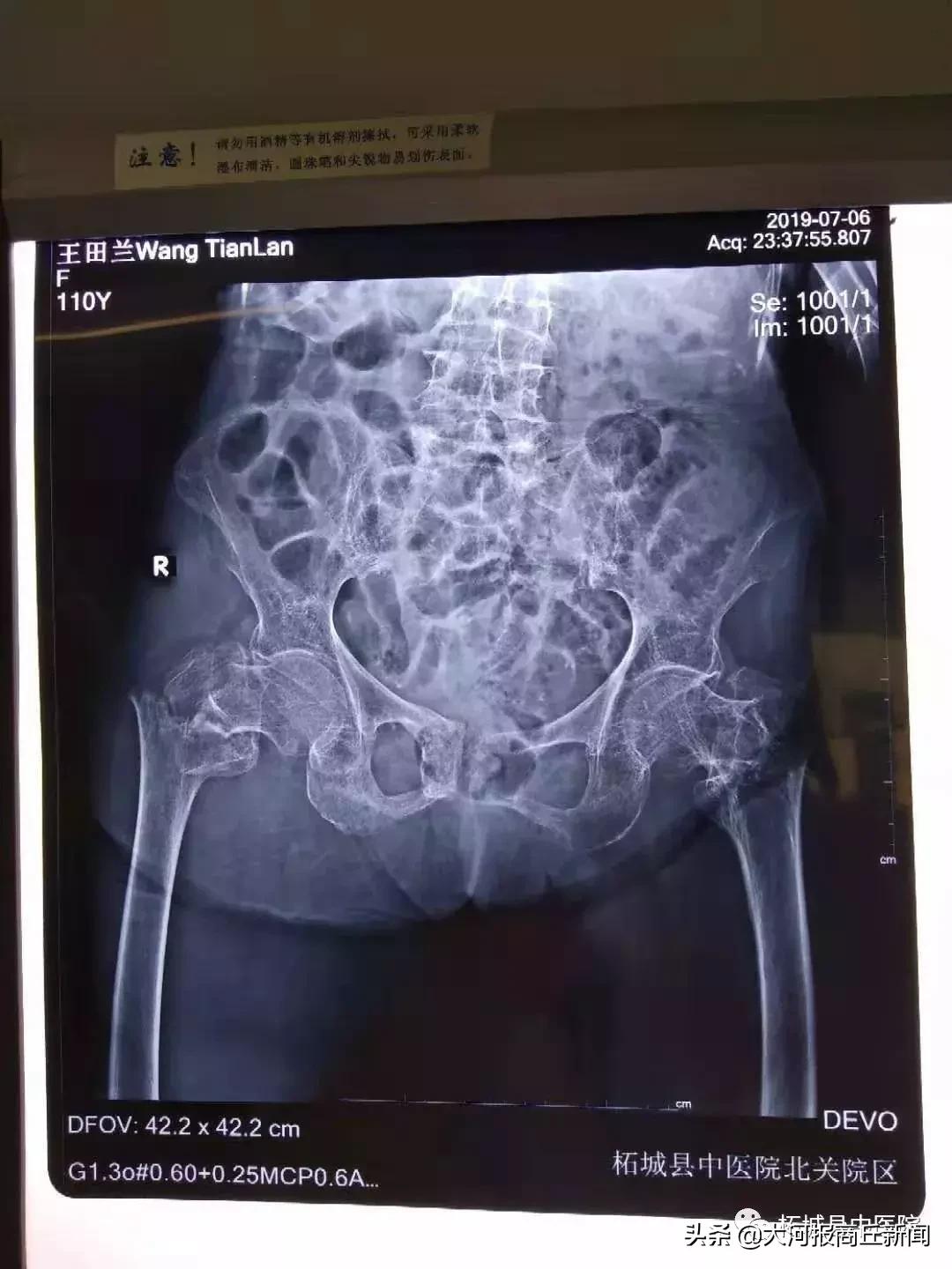 110岁了还能换关节？就在昨天，柘城县中医院北关院区完成了这项创举