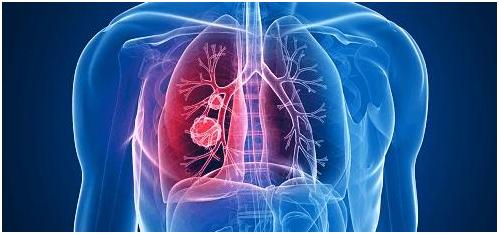 肺癌定义、病因、病理及病理组织学分类