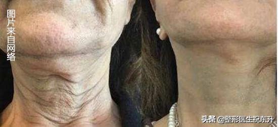 你的皱纹是怎样的,你的颈纹是这样的吗