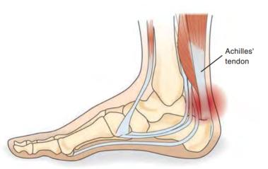 踝关节体态评估,体态评估如何评估踝关节内外翻