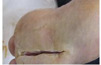 不典型的骨髓炎能根治吗,彻底治疗骨髓炎