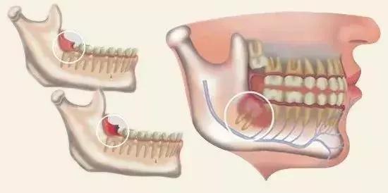 牙齿痛怎么办教你一招搞定牙痛,牙痛怎么样判断牙齿什么问题