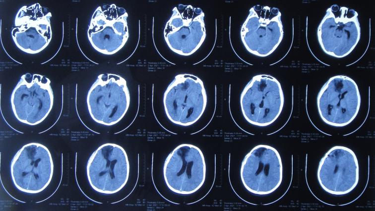 儿童脑出血昏迷三天后恢复正常了,脑出血后脑积水多久会出现症状