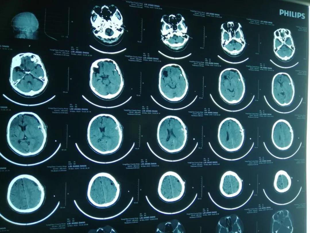 泉州:突破!永春县总医院成功开展新技术