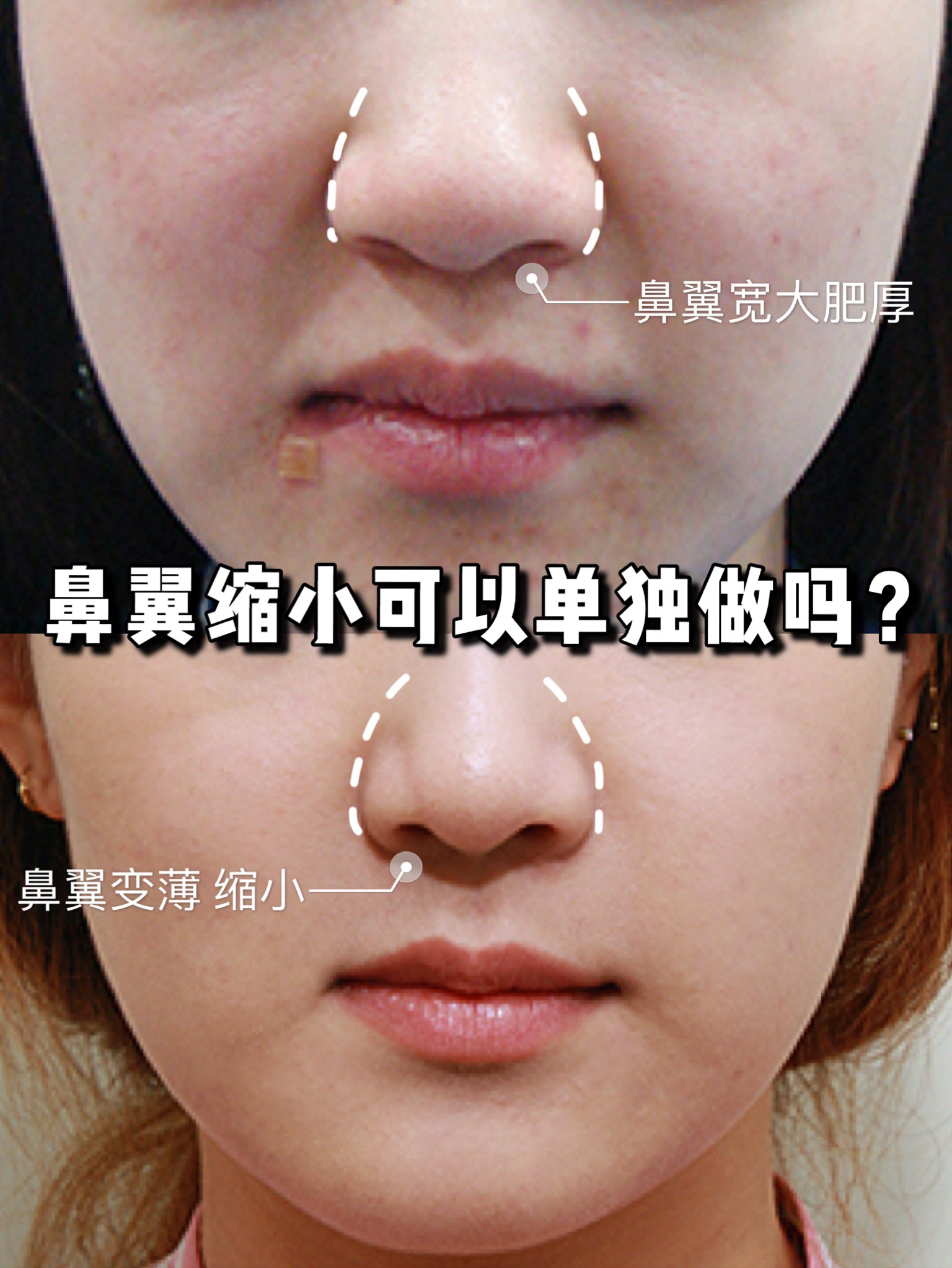 鼻翼缩小可以单独做吗,内切鼻翼缩小有效果吗