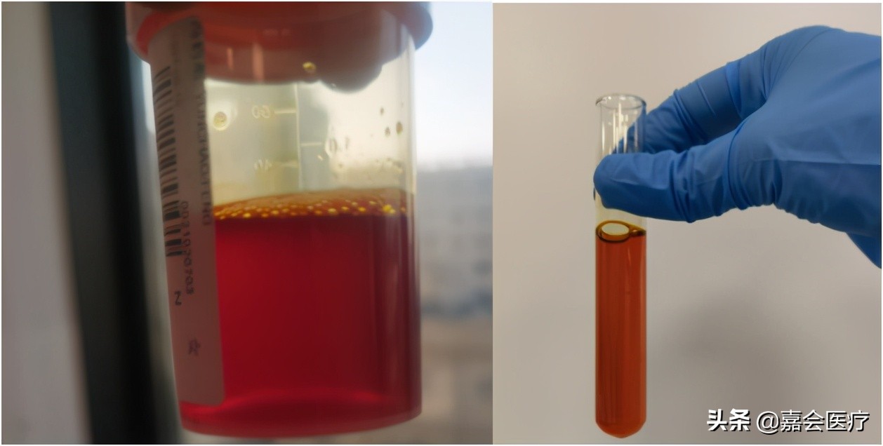 尿液突然变红、变绿?注意这些常见药会改变尿液颜色