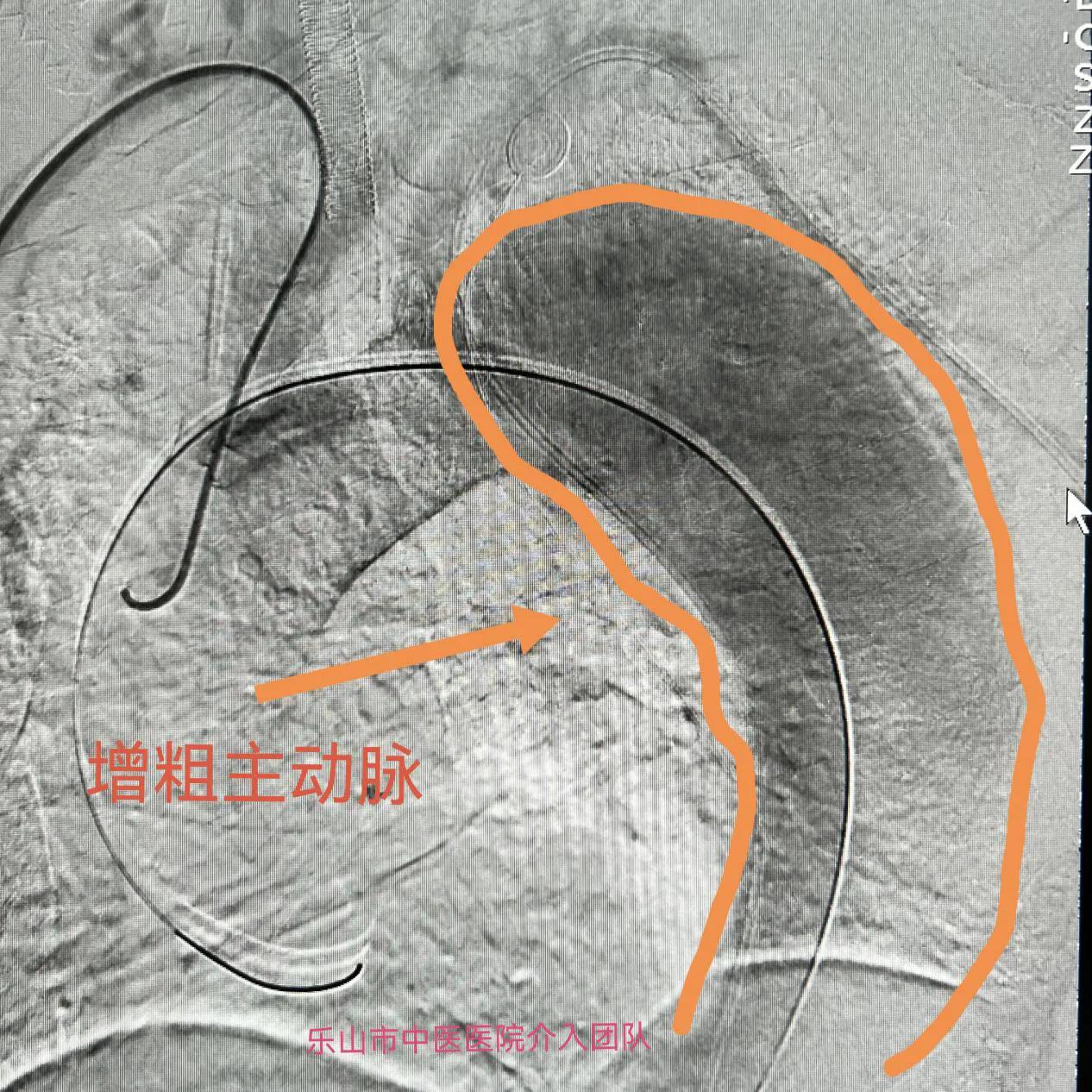 男子头胸藏“定时*弹炸**”我院成功完成一例多个血管夹层动脉瘤手术