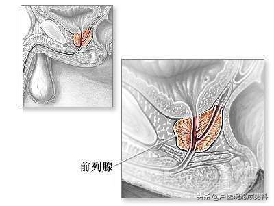 警惕前列腺癌这几点不容忽视,前列腺警惕非良性病变