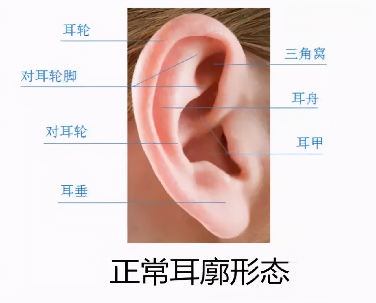 新生儿耳廓畸形需要抹什么药定型,新生儿耳朵轮廓畸形家长怎么办