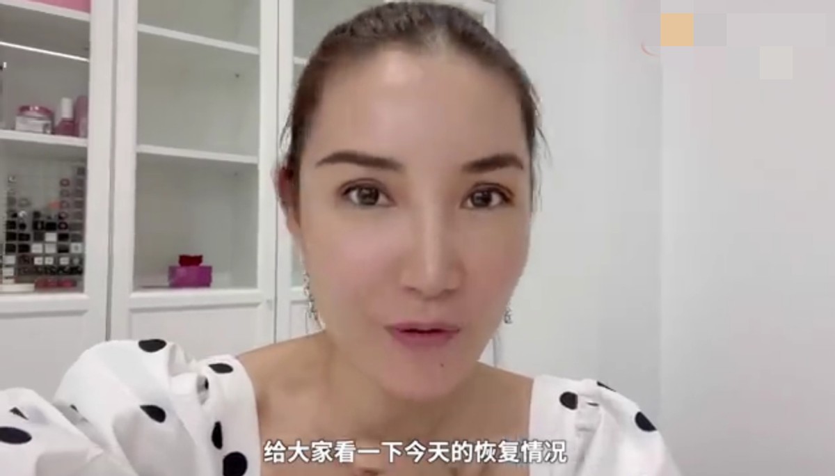 央视报道整容手术,女明星割双眼皮前后