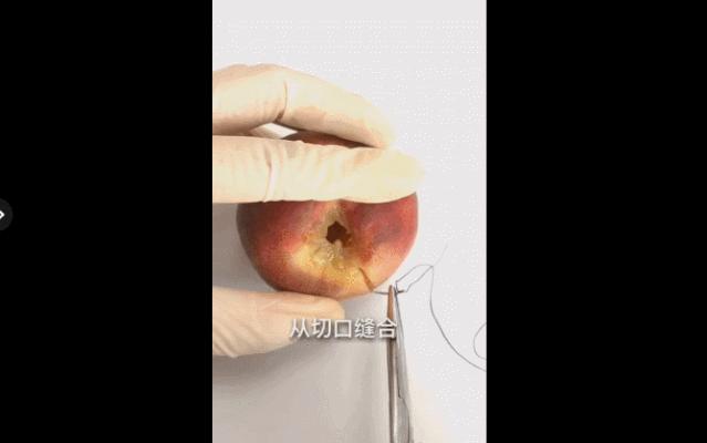 顺产侧切会不会留下后遗症?真相是?