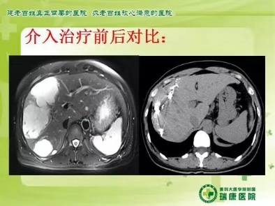 肝血管瘤做微创好还是手术好,巨大肝血管瘤介入手术缺点