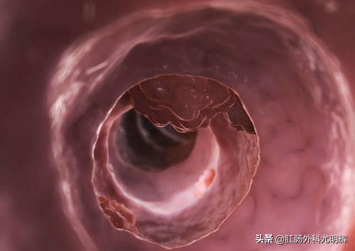3公分肠道息肉如何切除,肠道息肉6毫米要切除吗