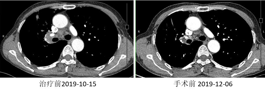 PD-1新辅助治疗初探，典型案例汇总一览