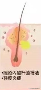 疮可以用针挑掉吗,痘疮净可以祛痘吗