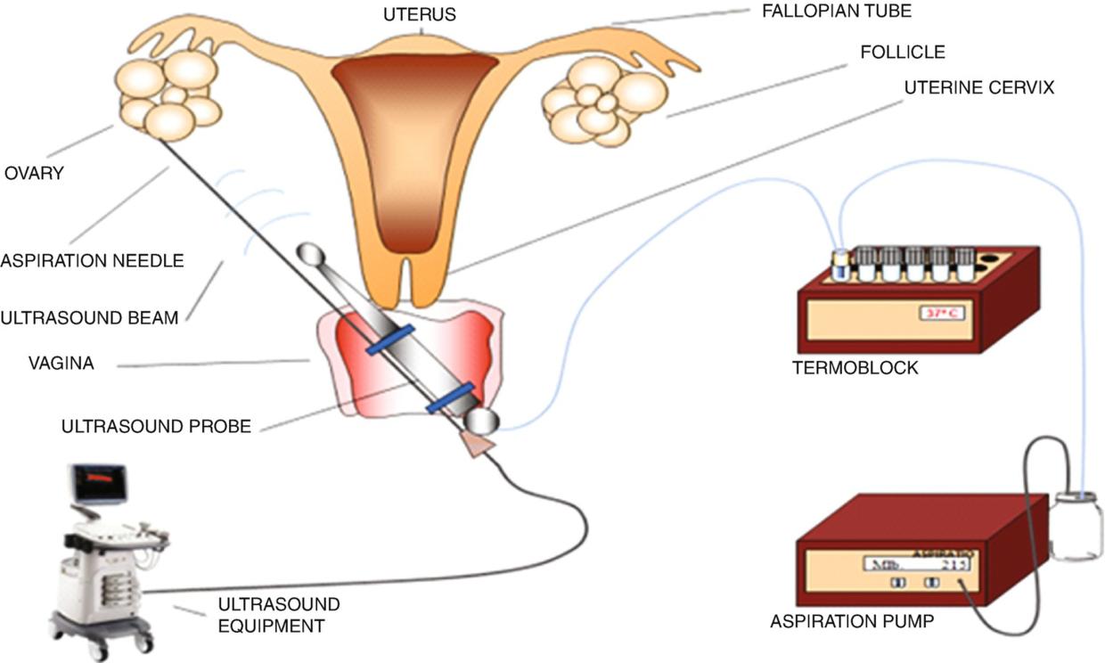 捐卵黑幕,捐卵骗局真人