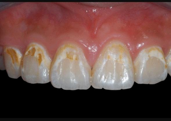 尿酸高会导致牙齿脱落吗,尿酸高会引起嘴唇干吗