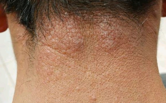 神经性皮炎裹保鲜膜可以吗,神经性皮炎治不好