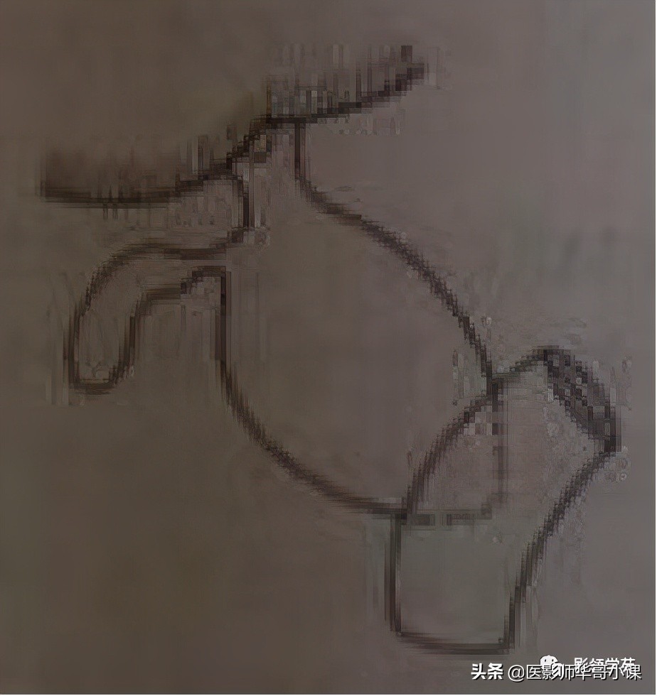 胆总管变异,胆胰管解剖