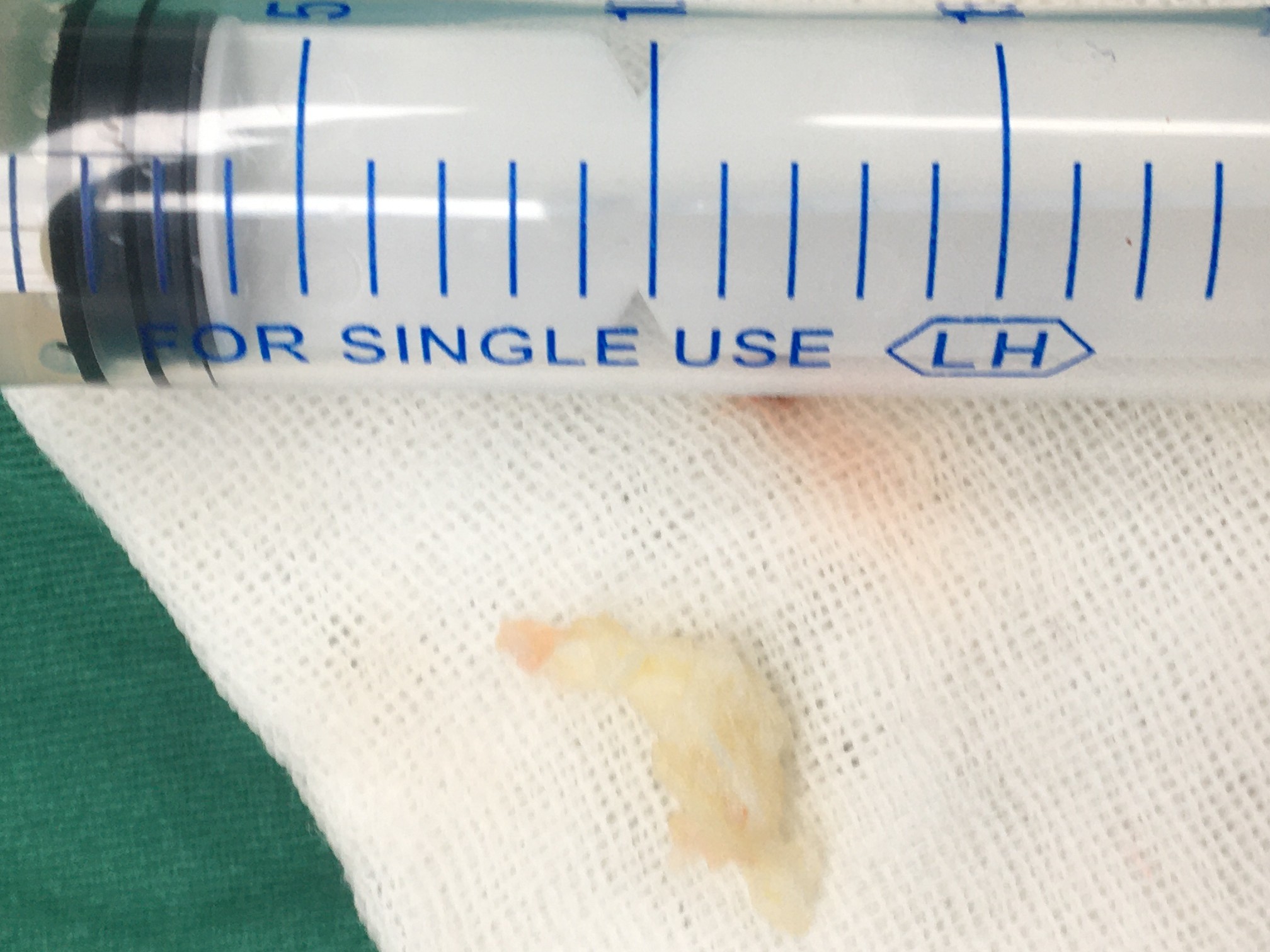 巨大颈椎间盘突出,疼痛日夜不宁,陈明博士微创孔镜后彻底康复