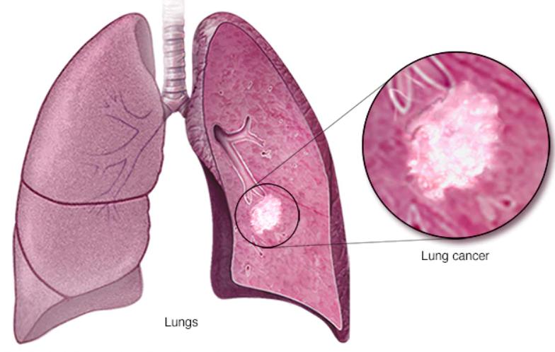 早期癌症会大出血吗,早期癌症如何发现