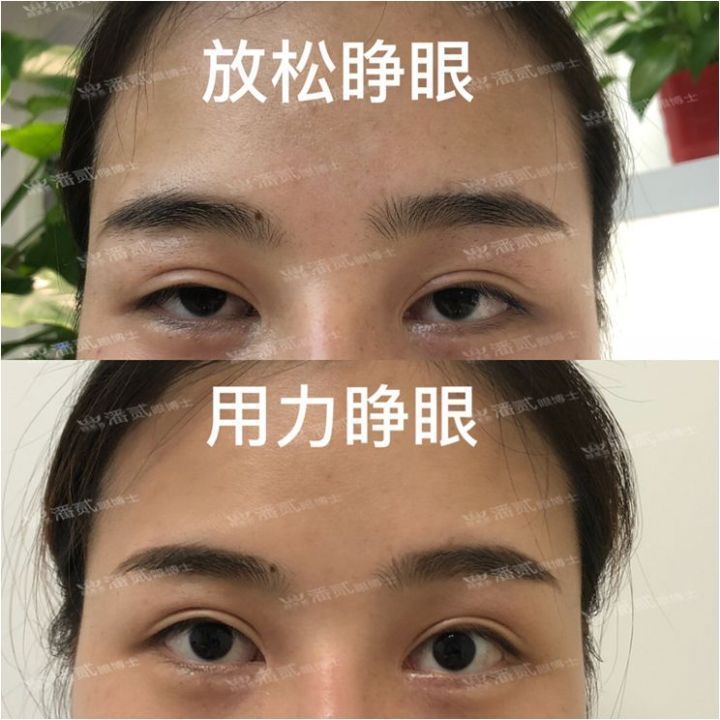 双眼皮手术科普：割双眼皮七大常见误区，您中招了几个？