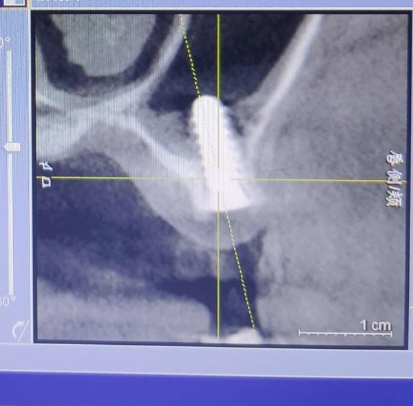 私人诊所种植牙会不会以次充好,丹东公立医院种牙
