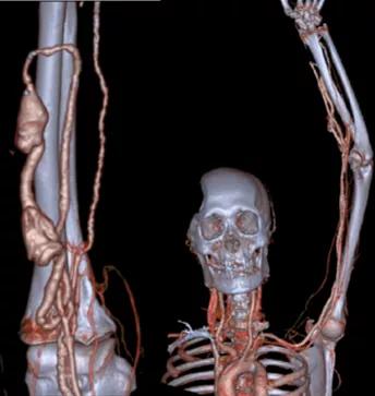 dsa食管狭窄球囊扩张术,经皮静脉超声引导下球囊扩张术