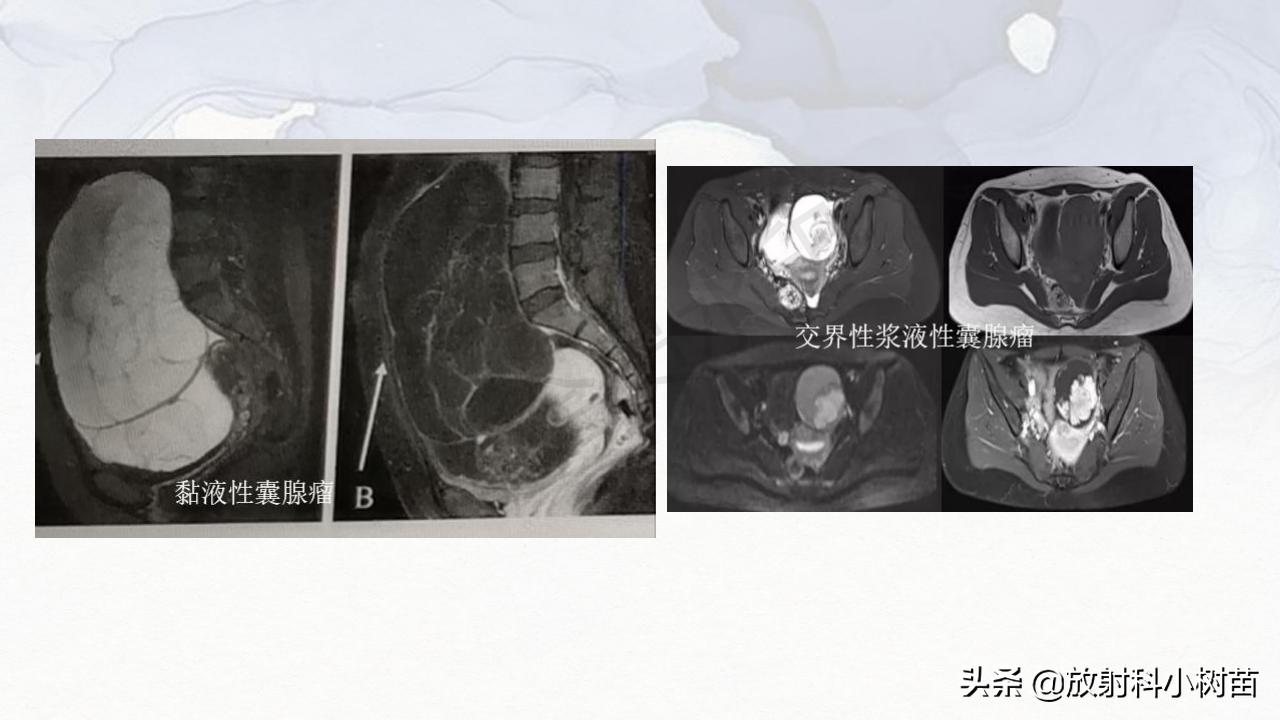 女性盆腔mri解剖图谱,泌尿生殖系统x线解剖